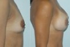 Breast Fat Transfer Case Study