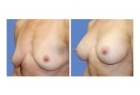 Breast Fat Transfer Case Study