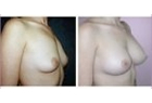 Breast Fat Transfer Case Study